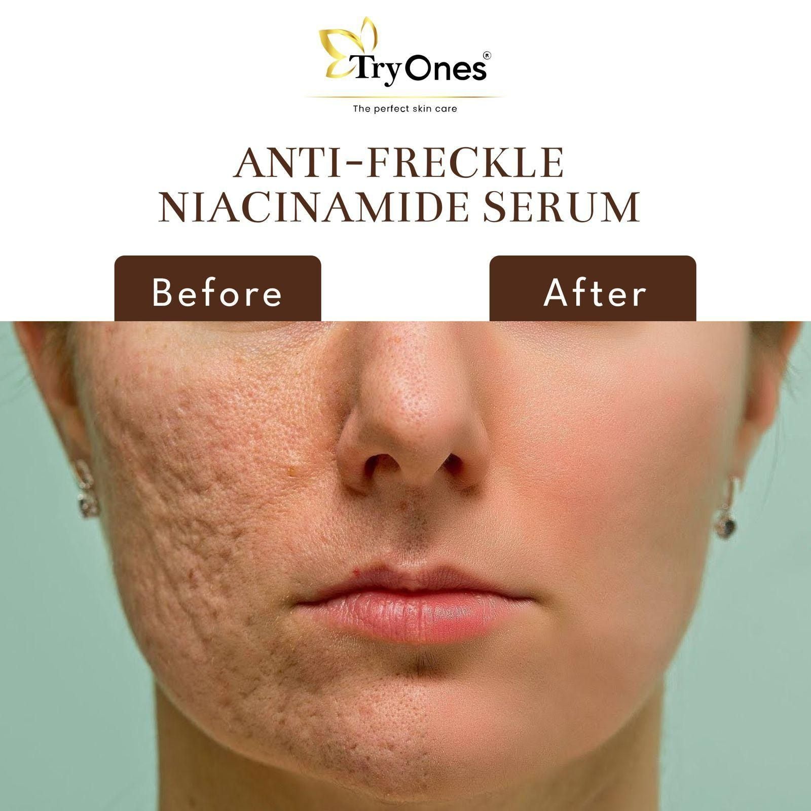 TryOnes Anti Freckle Niacinamide Face Serum 30ml